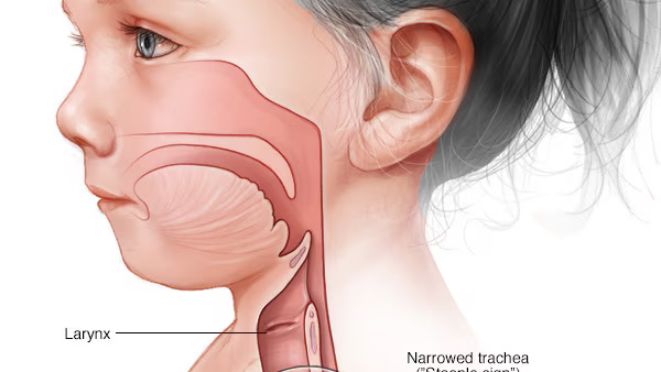 Ventilación crónica y traqueostomizados